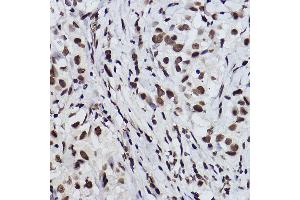 Immunohistochemistry of paraffin-embedded human breast cancer using Acetyl-Histone H3-K27 Rabbit mAb (ABIN3016650, ABIN3016651, ABIN3016652, ABIN1682513 and ABIN1682514) at dilution of 1:100 (40x lens). (Histone 3 抗体  (acLys27))