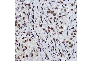 Immunohistochemistry of paraffin-embedded human breast cancer using Acetyl-Histone H3-K27 Rabbit mAb (ABIN3016650, ABIN3016651, ABIN3016652, ABIN1682513 and ABIN1682514) at dilution of 1:100 (40x lens). (Histone H3 (Acetyl K27) (acLys27) 抗体)