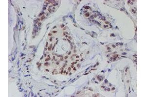 Immunohistochemical staining of paraffin-embedded Carcinoma of Human pancreas tissue using anti-TDO2 mouse monoclonal antibody. (TDO2 抗体)