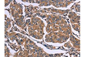 The image on the left is immunohistochemistry of paraffin-embedded Human breast cancer tissue using ABIN7190535(EGR4 Antibody) at dilution 1/20, on the right is treated with synthetic peptide. (EGR4 抗体)