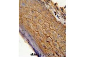 CB2 antibody (C-term) immunohistochemistry analysis in formalin fixed and paraffin embedded human skin carcinoma followed by peroxidase conjugation of the secondary antibody and DAB staining. (CNR2 抗体  (C-Term))