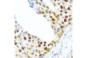 Immunohistochemistry of paraffin-embedded human prostate cancer using KHDRBS2 antibody. (KHDRBS2 抗体  (C-Term))