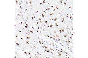 Immunohistochemistry of paraffin-embedded human esophageal cancer using LEO1 Rabbit pAb (ABIN6133790, ABIN6143141 and ABIN7101832) at dilution of 1:100 (40x lens).