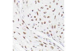 Immunohistochemistry of paraffin-embedded human esophageal cancer using LEO1 Rabbit pAb (ABIN6133790, ABIN6143141 and ABIN7101832) at dilution of 1:100 (40x lens). (LEO1 抗体)