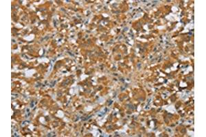 The image on the left is immunohistochemistry of paraffin-embedded Human thyroid cancer tissue using ABIN7190675(FOXB1 Antibody) at dilution 1/30, on the right is treated with synthetic peptide. (FOXB1 抗体)