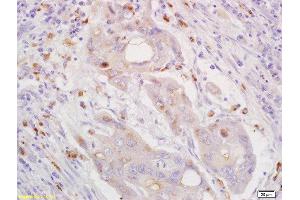 Formalin-fixed and paraffin embedded human lung carcinoma labeled with Rabbit Anti CXorf36 Polyclonal Antibody, Unconjugated  at 1:200 followed by conjugation to the secondary antibody and DAB staining (CXORF36 抗体  (AA 91-182))