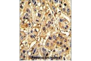 Formalin-fixed and paraffin-embedded human hepatocarcinoma with SFRP5 Antibody (Center), which was peroxidase-conjugated to the secondary antibody, followed by DAB staining. (SFRP5 抗体  (AA 219-248))
