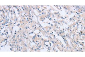 Immunohistochemistry of paraffin-embedded Human thyroid cancer tissue using AGAP2 Polyclonal Antibody at dilution 1:60 (AGAP2 抗体)