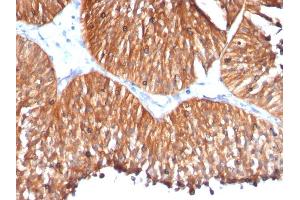 Formalin-fixed, paraffin-embedded human Bladder Carcinoma stained with HSP60 Mouse Monoclonal Antibody (HSPD1/780) (HSPD1 抗体)