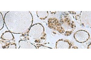 Immunohistochemistry of paraffin-embedded Human thyroid cancer tissue using PTPA Polyclonal Antibody at dilution of 1:50(x200)