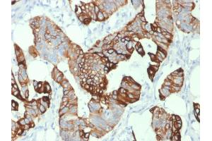 Formalin-fixed, paraffin-embedded human Colon Carcinoma stained with Cytokeratin 20 (KRT20) Mouse Monoclonal Antibody (KRT20/1993).