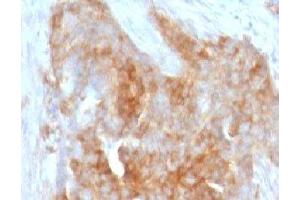 IHC testing of FFPE human ovarian carcinoma with Fascin antibody (clone FAN55-1) (Fascin 抗体)