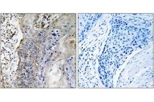 Immunohistochemistry analysis of paraffin-embedded human lung carcinoma tissue, using SLC28A2 Antibody.