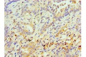 Immunohistochemistry of paraffin-embedded human lung cancer using ABIN7158299 at dilution of 1:100