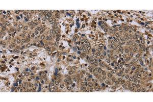 Immunohistochemistry of paraffin-embedded Human liver cancer tissue using NLRP4 Polyclonal Antibody at dilution 1:40 (NLRP4 抗体)