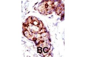 Formalin-fixed and paraffin-embedded human cancer tissue reacted with the primary antibody, which was peroxidase-conjugated to the secondary antibody, followed by AEC staining. (TSG101 抗体  (N-Term))