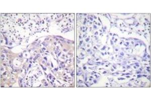 Immunohistochemistry analysis of paraffin-embedded human breast carcinoma, using ADD1 (Phospho-Thr445) Antibody. (alpha Adducin 抗体  (pThr445))