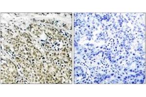 Immunohistochemistry analysis of paraffin-embedded human prostate carcinoma, using Androgen Receptor (Ab-213) Antibody. (Androgen Receptor 抗体  (AA 186-235))