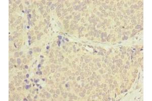 Immunohistochemistry of paraffin-embedded human gastric cancer using ABIN7173631 at dilution of 1:100 (TSACC/C1orf182 抗体  (AA 1-125))