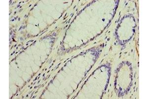Immunohistochemistry of paraffin-embedded human colon cancer using ABIN7154312 at dilution of 1:100 (GS28 抗体  (AA 1-115))