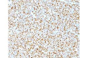IHC testing of human mantle cell lymphoma stained with Cyclin D1 antibody.