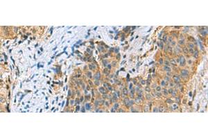 Immunohistochemistry of paraffin-embedded Human cervical cancer tissue using PSMA6 Polyclonal Antibody at dilution of 1:90(x200) (PSMA6 抗体)