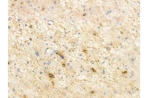 ABIN6261315 and ABIN6266717 at 1/100 staining human astrocytoma by IHC-P.