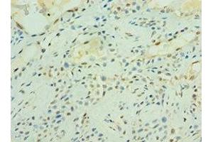 Immunohistochemistry of paraffin-embedded human breast cancer using ABIN7166484 at dilution of 1:100 (MAS1 抗体  (AA 246-325))