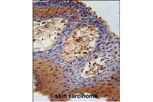 DHRS2 Antibody (C-term) (ABIN651532 and ABIN2840282) immunohistochemistry analysis in formalin fixed and paraffin embedded human skin carcinoma followed by peroxidase conjugation of the secondary antibody and DAB staining. (DHRS2 抗体  (C-Term))