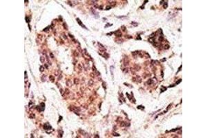 IHC analysis of FFPE human breast carcinoma tissue stained with the PGP9. (UCHL1 抗体  (AA 187-216))