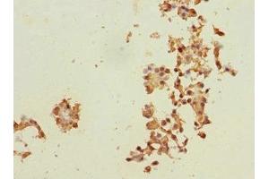 Immunohistochemistry of paraffin-embedded human breast cancer using ABIN7150598 at dilution of 1:100 (Ribophorin II 抗体  (AA 360-540))