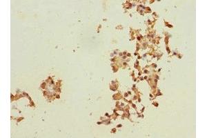 Immunohistochemistry of paraffin-embedded human breast cancer using ABIN7150598 at dilution of 1:100 (Ribophorin II 抗体  (AA 360-540))