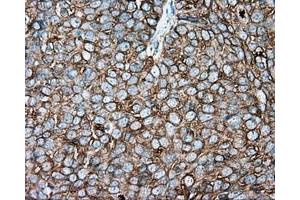 Immunohistochemical staining of paraffin-embedded Adenocarcinoma of colon tissue using anti-TUBA8 mouse monoclonal antibody. (TUBA8 抗体)