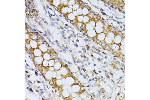 Immunohistochemistry of paraffin-embedded human colon using CCDC92 antibody (ABIN5974817) at dilution of 1/100 (40x lens). (CCDC92 抗体)