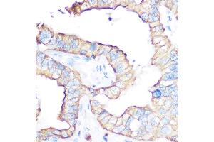 Immunohistochemistry of paraffin-embedded human liver cancer using CD47 antibody (ABIN6127604, ABIN6138199, ABIN6138201 and ABIN6223104) at dilution of 1:100 (40x lens). (CD47 抗体  (AA 20-140))
