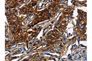 The image on the left is immunohistochemistry of paraffin-embedded Human lung cancer tissue using ABIN7189591(ABCC5 Antibody) at dilution 1/50, on the right is treated with synthetic peptide.