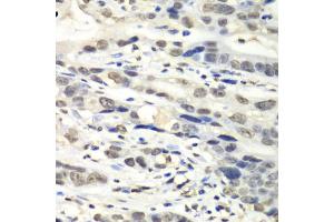 Immunohistochemistry of paraffin-embedded human gastric cancer using NUDT1 antibody. (NUDT1 抗体)