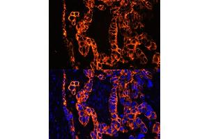 Immunofluorescence analysis of human lung cancer using Cytokeratin 7 (Cytokeratin 7 (KRT7)) antibody (ABIN6129292, ABIN6143037, ABIN6143039 and ABIN6215559) at dilution of 1:100. (Cytokeratin 7 抗体  (AA 1-94))