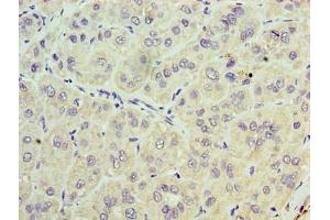 Immunohistochemistry of paraffin-embedded human liver cancer using ABIN7171285 at dilution of 1:100 (TRBC1 抗体  (AA 1-176))