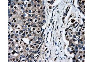 Immunohistochemical staining of paraffin-embedded Adenocarcinoma of ovary tissue using anti-RALBP1mouse monoclonal antibody. (RALBP1 抗体)