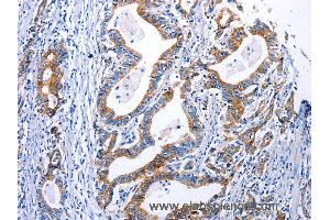 Immunohistochemistry of Human gastric cancer using DRD4 Polyclonal Antibody at dilution of 1:30 (DRD4 抗体)