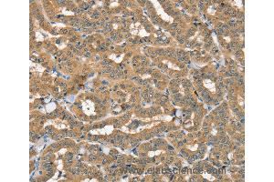 Immunohistochemistry of Human thyroid cancer using SEC14L2 Polyclonal Antibody at dilution of 1:40 (SEC14L2 抗体)