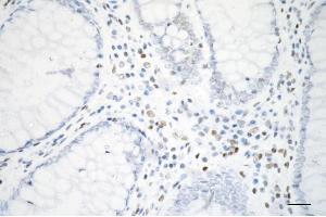 Immunohistochemistry was performed on paraffin-embedded human sigmoid colon carcinoma using histone H3 (acetyl K10) antibody (ABIN7798973), 1:200). (Recombinant Histone 3 抗体  (H3K9ac))