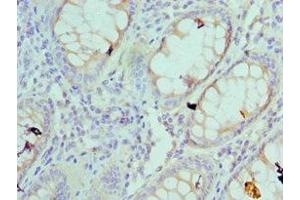 Immunohistochemistry of paraffin-embedded human colon cancer using ABIN7142558 at dilution of 1:100 (RPS4X 抗体  (AA 66-263))