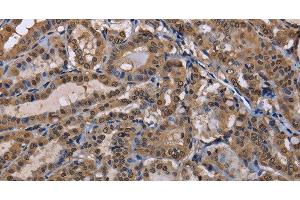 Immunohistochemistry of paraffin-embedded Human thyroid cancer using CUL3 Polyclonal Antibody at dilution of 1:30 (Cullin 3 抗体)
