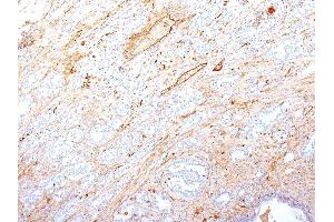 Formalin-fixed, paraffin-embedded human Pancreatic Adenocarcinoma stained with Fibronectin Monoclonal Antibody (SPM246). (Fibronectin 1 抗体)
