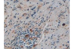 Detection of GSN in Human Prostate cancer Tissue using Polyclonal Antibody to Gelsolin (GSN)