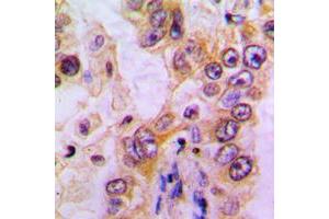 Immunohistochemical analysis of EHHADH staining in human liver cancer formalin fixed paraffin embedded tissue section. (EHHADH 抗体  (Center))