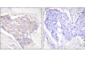 Immunohistochemistry analysis of paraffin-embedded human breast carcinoma tissue, using BIM Antibody. (BIM 抗体  (AA 1-50))