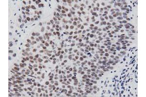 Immunohistochemical staining of paraffin-embedded Carcinoma of Human bladder tissue using anti-PTPRE mouse monoclonal antibody. (PTPRE 抗体)